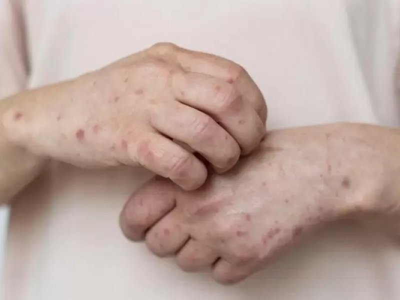 Imagem de Ministério da Saúde amplia testagem de varíola dos macacos
