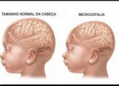 Imagem de Número de casos notificados de microcefalia na Bahia chega a 648, diz Sesab