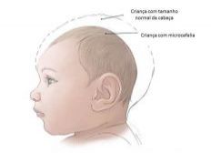 Imagem de Brasil registra 1.434 casos de bebês com microcefalia