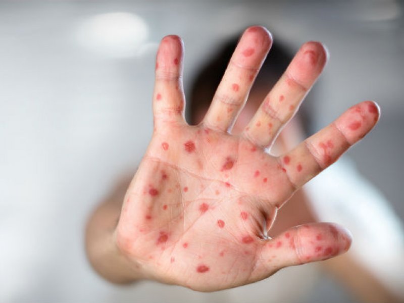 Imagem de OMS alerta para aumento de casos de sarampo no mundo