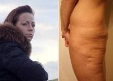 Imagem de Após perder 50 kg, mulher vive pesadelo com bumbum: "parece que um tubarão mordeu"
