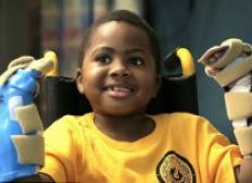 Imagem de Menino de oito anos recebe transplante duplo de mãos nos EUA