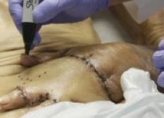 Imagem de Paciente tem mão "costurada" na barriga