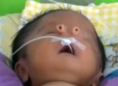 Imagem de Bebê nasce com nariz deformado
