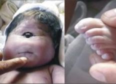 Imagem de Criança nasce com um olho