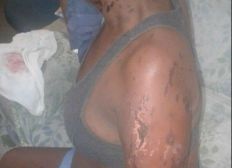Imagem de Mulher é atacada com ácido por ex-namorado após término de relação no bairro da Sete Porta