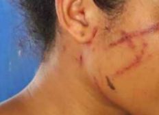 Imagem de Adolescente de 13 anos é agredida por ex-namorado e sofre ferimentos no rosto no sul da BA