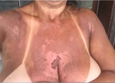 Imagem de Quatro mulheres denunciam clínica por queimaduras durante bronzeamento natural com fitas em Itabuna