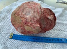 Imagem de Lavrador de 51 anos tem pedra de 1,3 Kg e 18 cm retirada da bexiga em cirurgia na Bahia