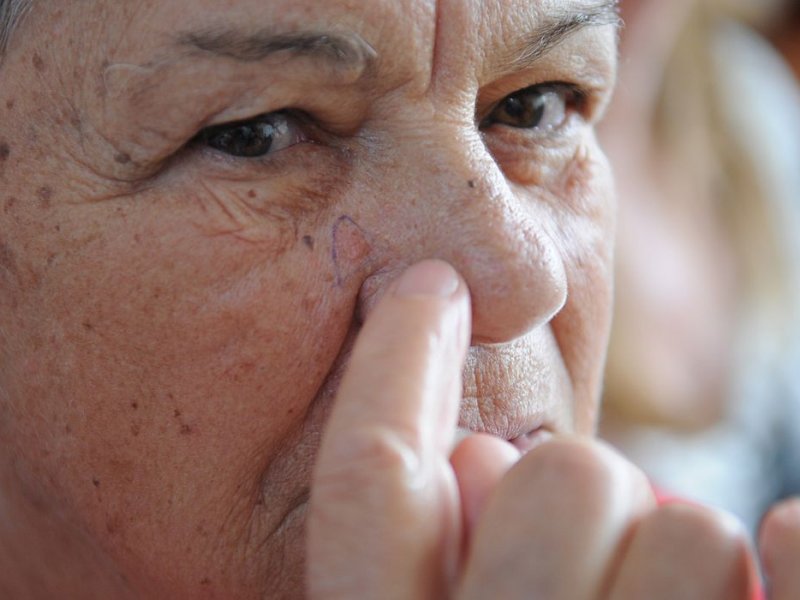 Imagem de Brasileiros devem redobrar cuidados no verão contra câncer de pele