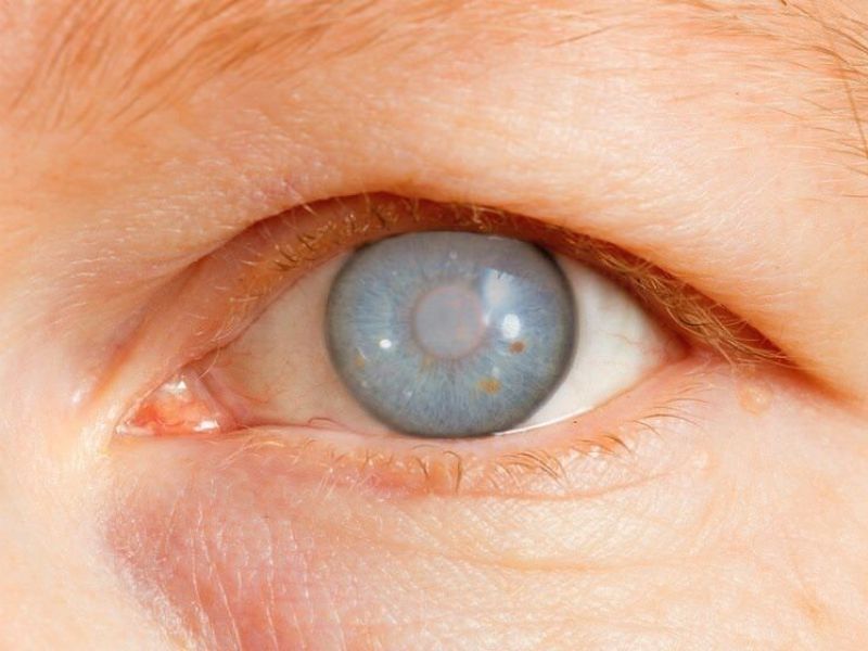 Imagem de WGA lança guia para evitar expansão de casos de cegueira por glaucoma