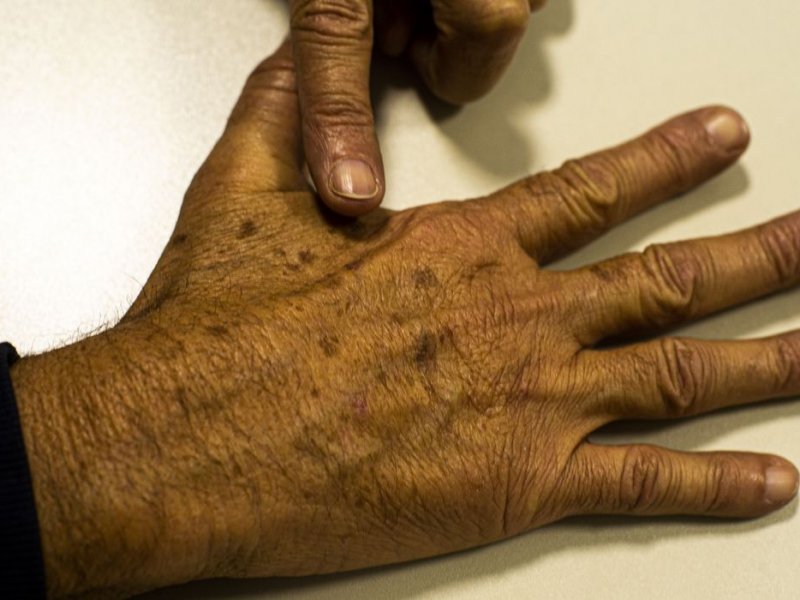 Imagem de Ministério da Saúde abre consulta sobre diagnóstico do câncer de pele