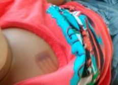 Imagem de Bebê é internado com marcas de queimaduras de garfo em PE